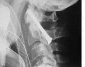 脊髓损伤有哪些临床表现