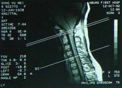 得了脊髓空洞症会有哪些表现