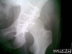 椎管狭窄的常见症状有哪些