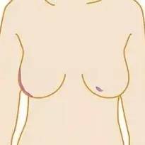 石家庄肿瘤医院教你预防乳腺癌