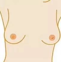 石家庄肿瘤医院教你预防乳腺癌