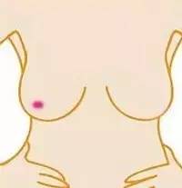 石家庄肿瘤医院教你预防乳腺癌