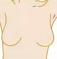 石家庄肿瘤医院教你预防乳腺癌