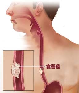 邯郸市癌症医院对引起食道癌的因素的介绍