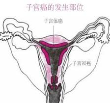 张家口市癌症医院讲解子宫癌中医分型表现知识