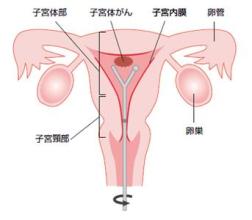 张家口市癌症医院告诉你有必要了解的子宫癌症状