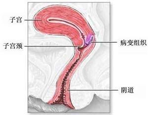 子宫癌病因有什么