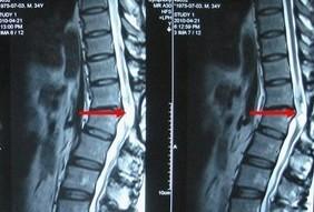 脊髓损伤有何临床表现